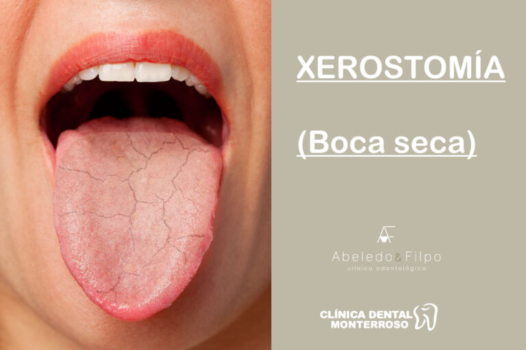A Respeito Da Xerostomia é Correto Afirmar Que